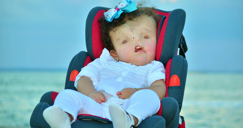 Девочка «словно с картины Пикассо» живет несмотря на диагнозы и прогнозы врачей 1