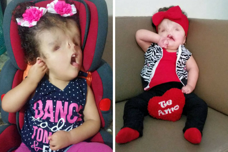 Девочка «словно с картины Пикассо» живет несмотря на диагнозы и прогнозы врачей 2