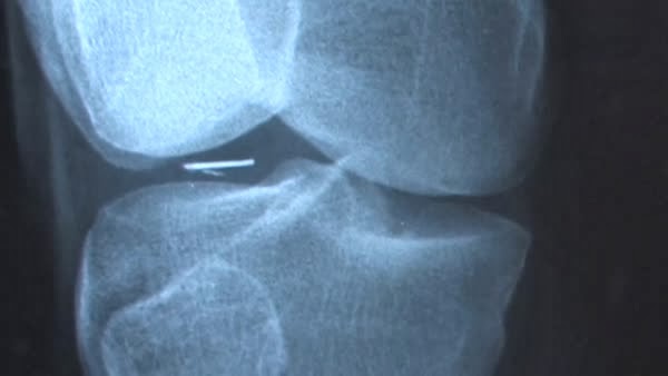 Доктор Роджер Лир и его исследование случаев внедрения в людей инопланетных имплантатов 1