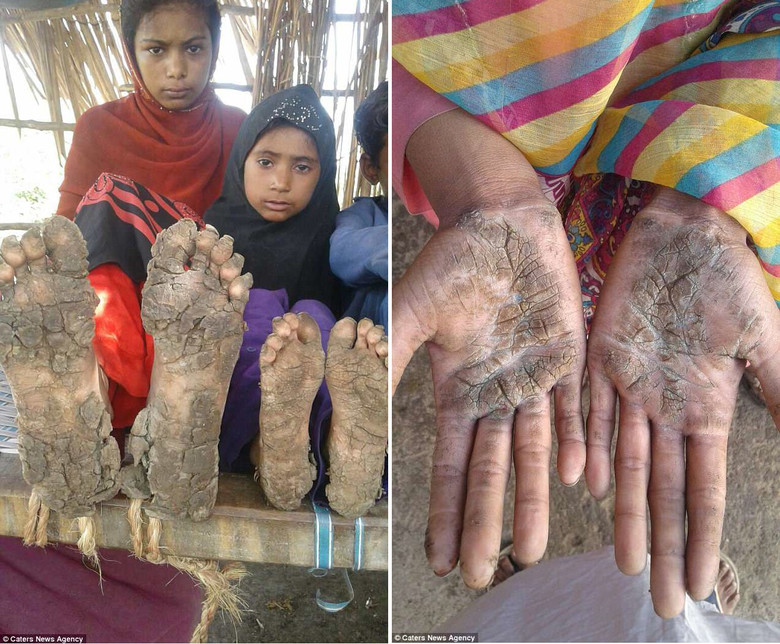Из-за редкой аномалии руки и ноги братьев и сестер обрастают толстой жесткой коркой 2