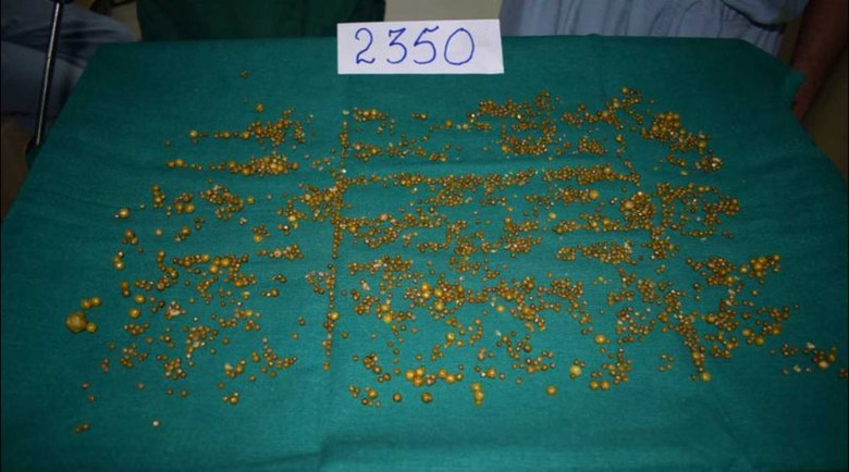 Из желчного пузыря индианки извлекли невероятные 2350 камней 1