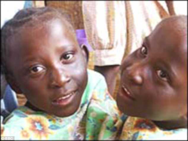 Танзанийские сиамские близнецы с одним телом на двоих скончались в 21 год 2