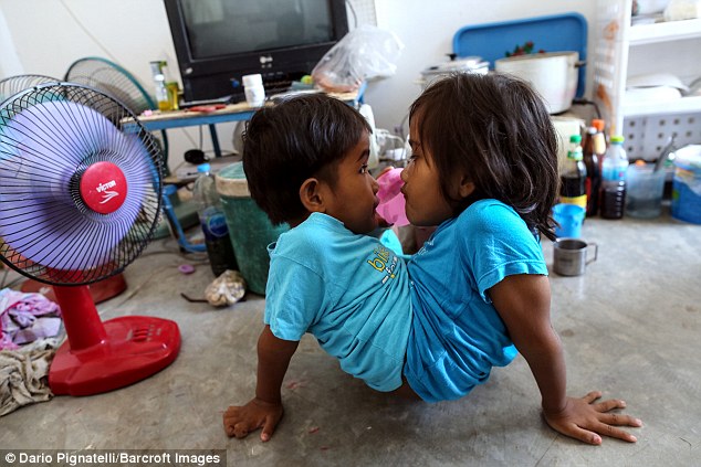 У 7-летних сиамских близнецов из Таиланда одна на двоих нижняя часть тела 1