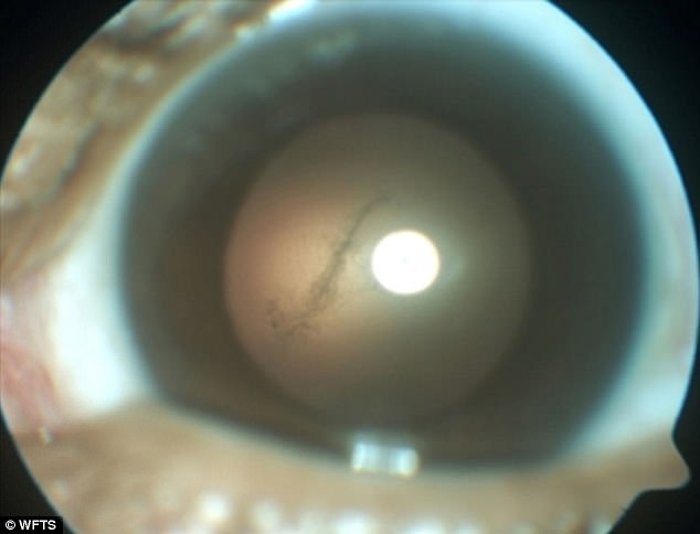 У жителя Флориды в глазу поселился свиной паразит 1