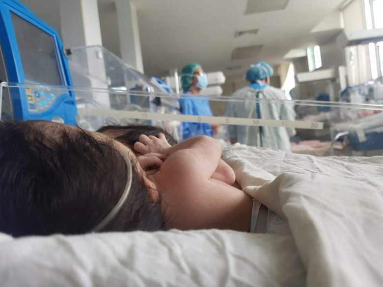 В Гондурасе сиамских близнецов с одним сердцем на двоих решили не разделять из-за рисков 1